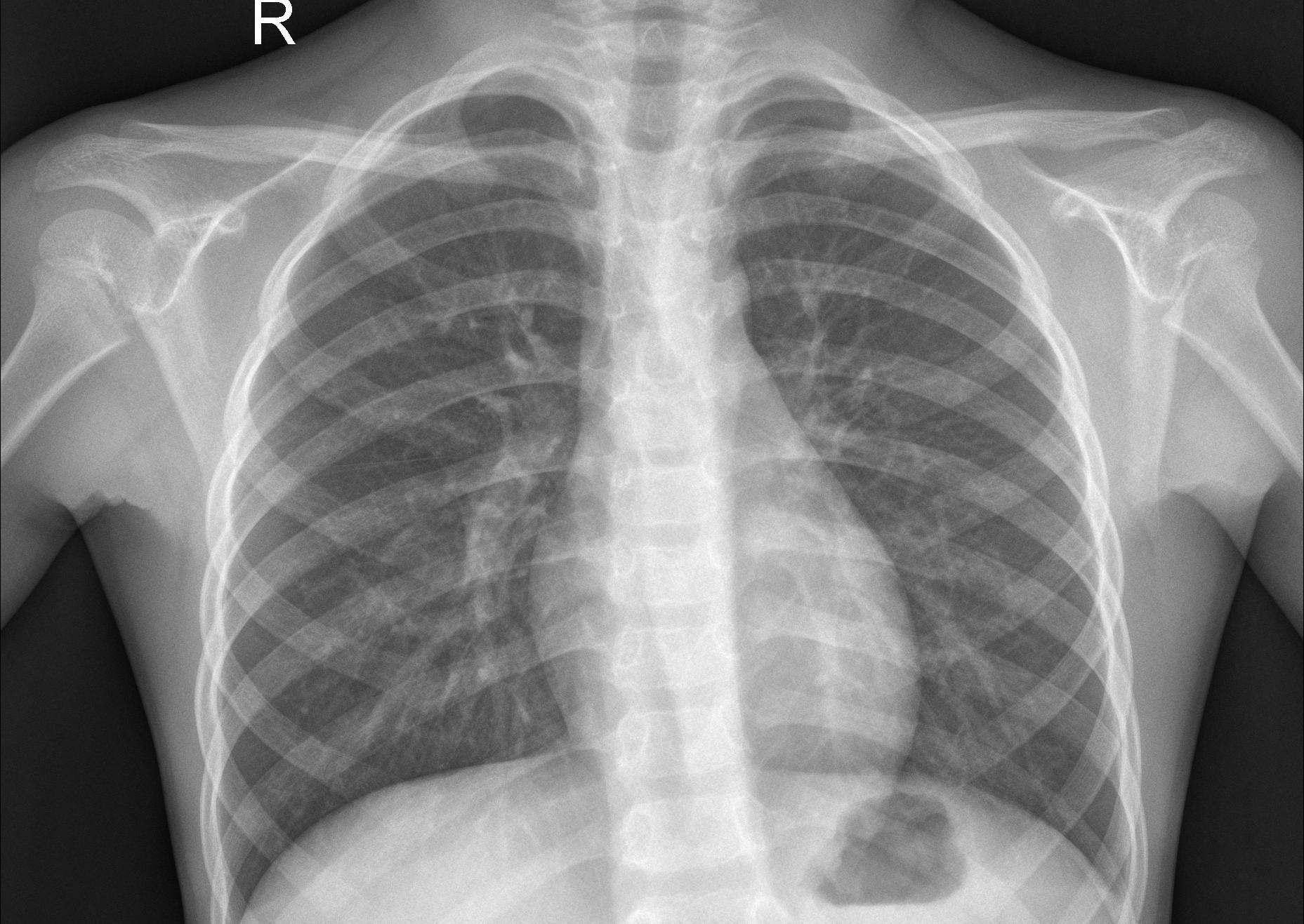 normal chest x-ray