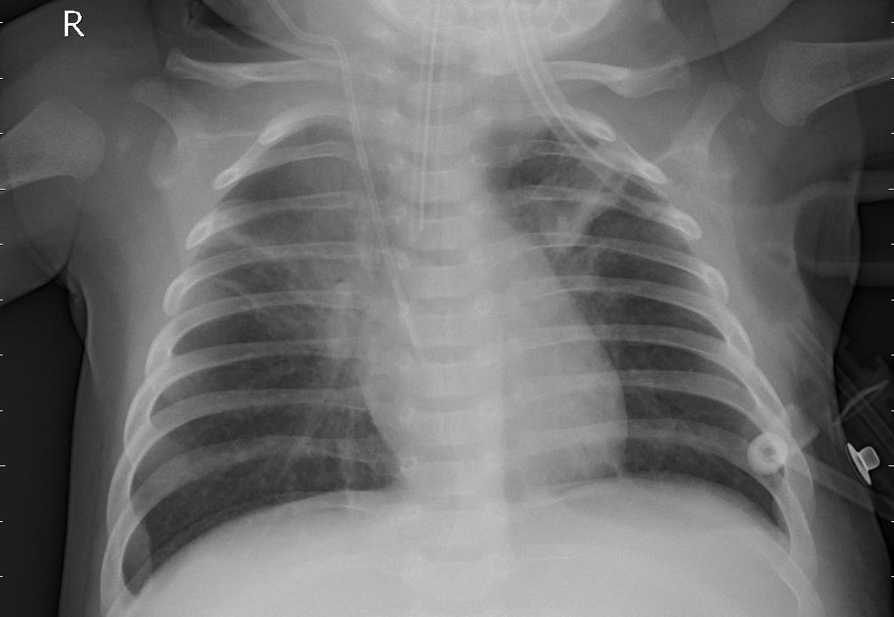 pneumonic chest x-ray